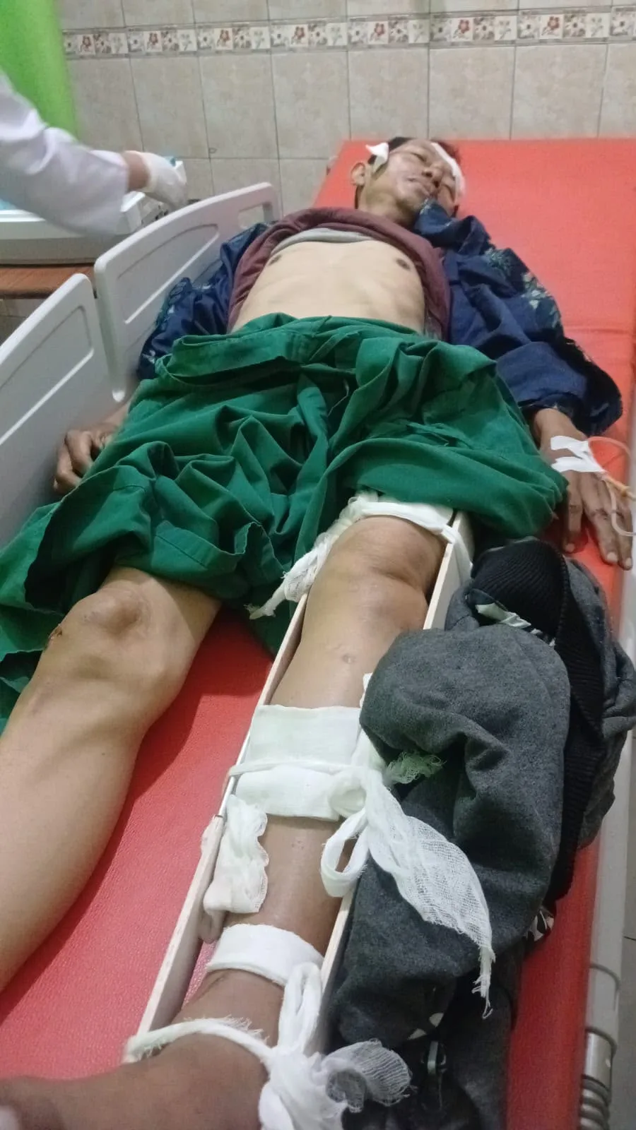 Tulang Kaki Patah akibat Kecelakaan, Guru ASN M. Ridwan Berjuang Pulih dengan JKK TASPEN