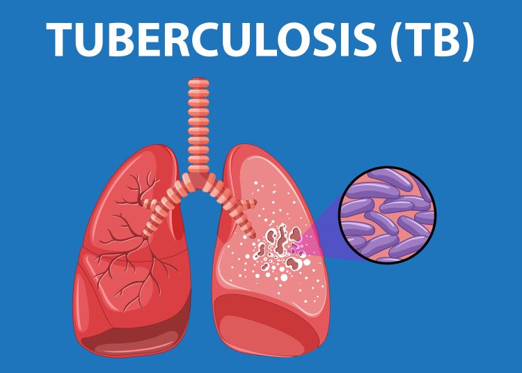 Pencapaian Gemilang Dinkes Medan: Target Kasus TB 2024 Tercapai Lebih Dari 100%